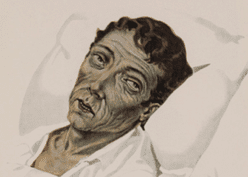 cholera